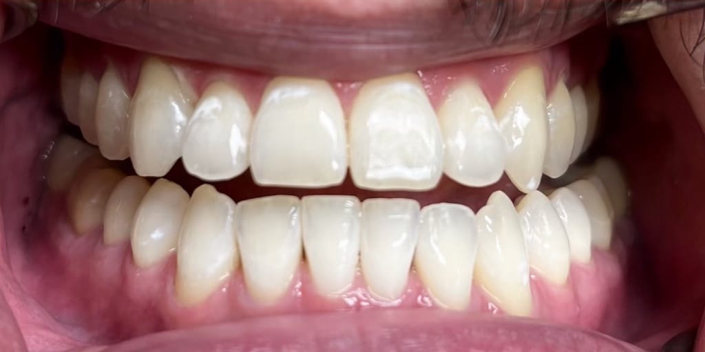 Hollywood Smile after