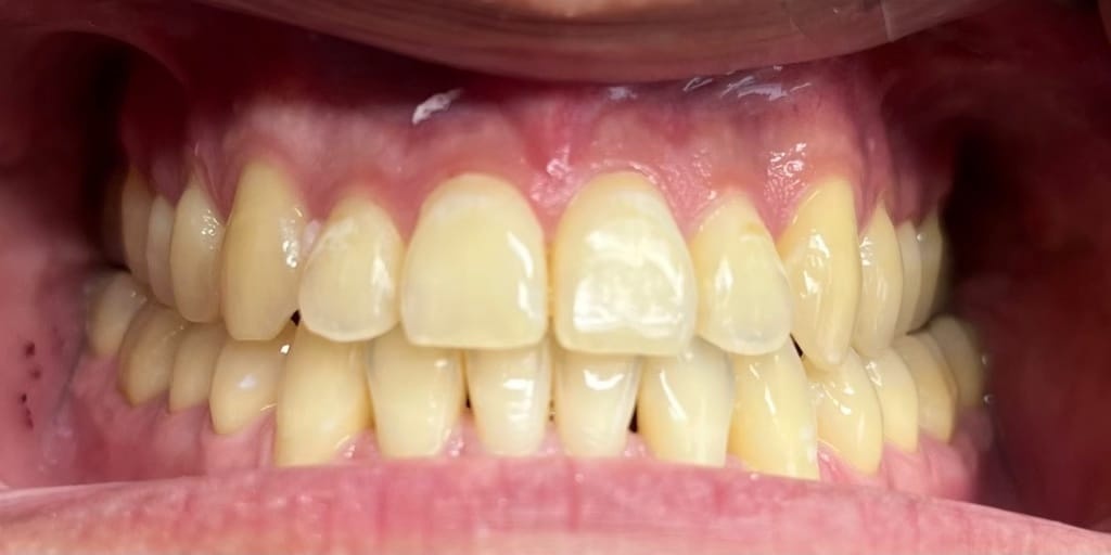 Hollywood Smile before