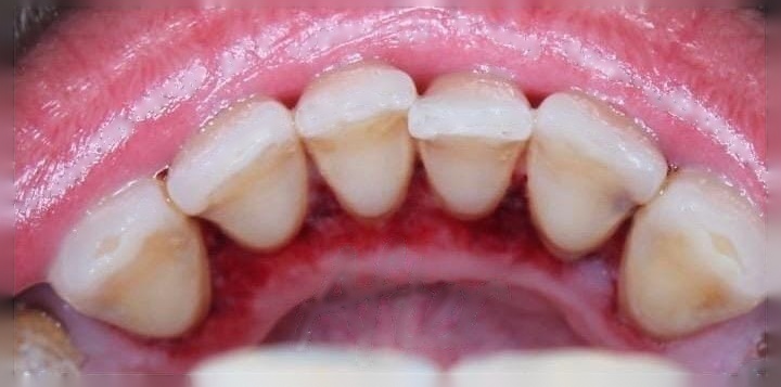 Dental Implant after