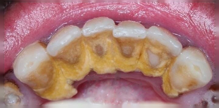Dental Implant before