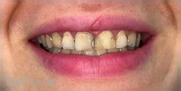 Oral Surgery before